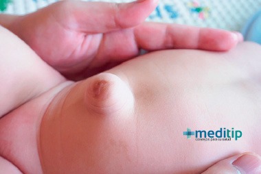 Bebé con hernia umbilical