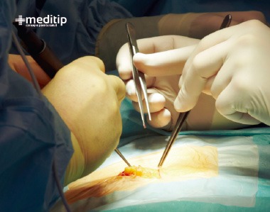 Cirugía de hernia femoral: vía laparoscópica