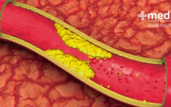 Enfermedad arterial periférica