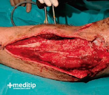 Heridas abiertas: definición, tipos y tratamiento - Meditip