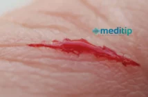 Heridas abiertas: definición, tipos y tratamiento