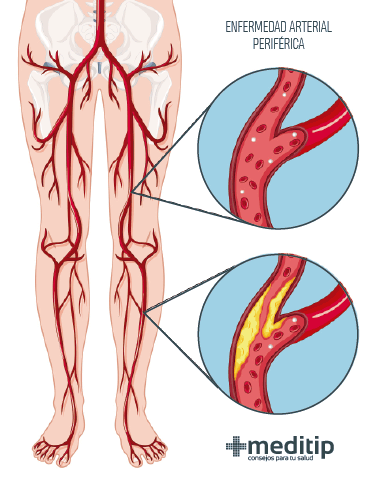 Dolor de pierna: enfermedad arterial periférica 