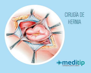 Ilustración de cirugía de reparación de hernias
