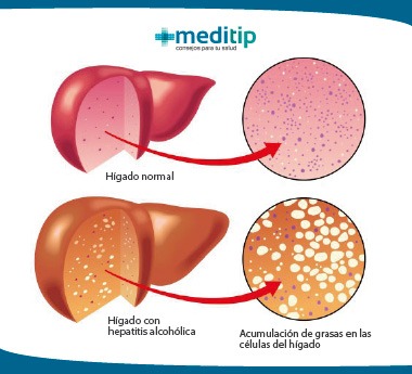 Ilustración de la hepatitis alcohólica