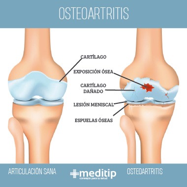 Infografía de osteoartritis o artrosis