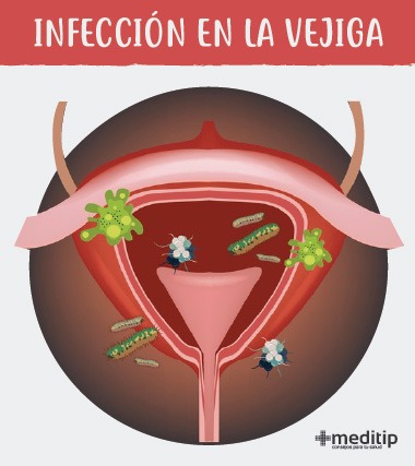 Infección de vías urinarias - Infección en la vejiga
