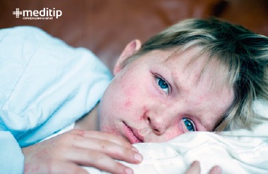 Primeros síntomas del sarampión: niño con malestar y fiebre