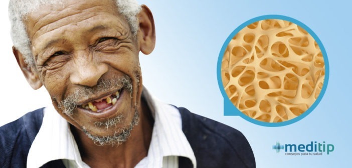 Osteoporosis y la pérdida de dientes