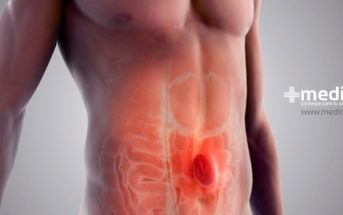 Tratamiento de hernias