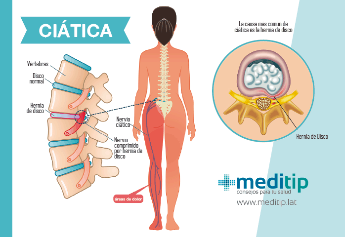 Infografía de la ciática, una de las enfermedades más comunes de la columna