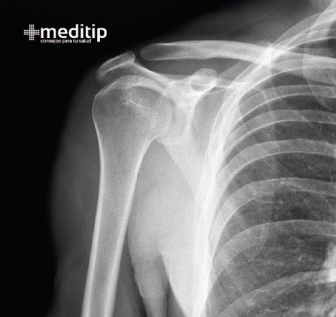 dolor de hombro: radiografía