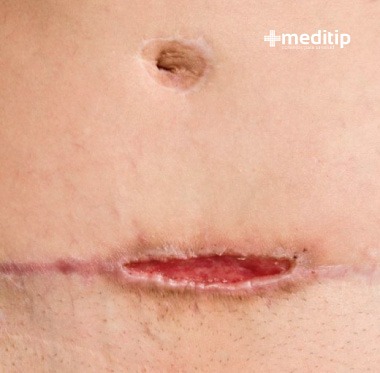 Dehiscencia quirúrgica de una cesárea, complicaciones de las heridas