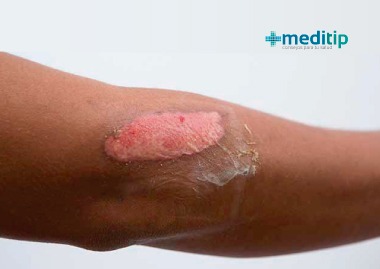 Ácido úrico y reparación de tejido: herida por quemadura