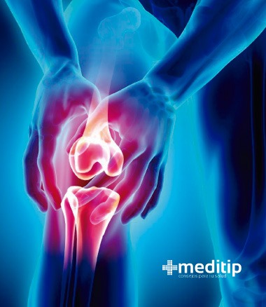 Causas comunes del dolor de rodilla: Condromalacia rotuliana
