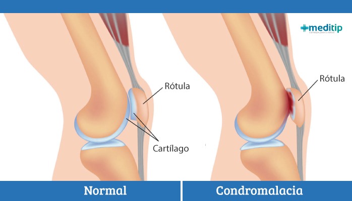 rodilla de corredor: desgaste de la rótula (patela)
