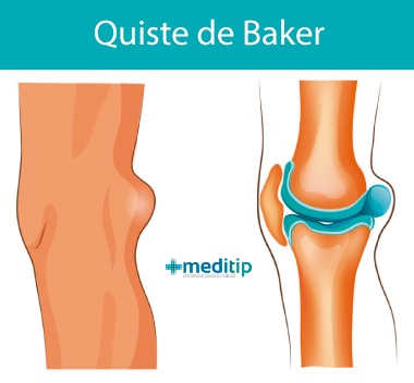 Quiste de Baker: inflamación detrás de la rodilla