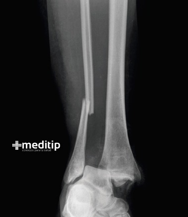 Fracturas: radiografía de fractura