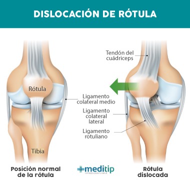 Causas de dolor de rodilla: dislocación de rótula