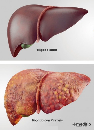 Causas de la cirrosis: hígado sano e hígado con cirrosis