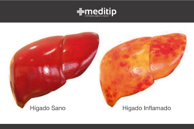 contagio de hepatitis A: hígado sano e hígado inflamado