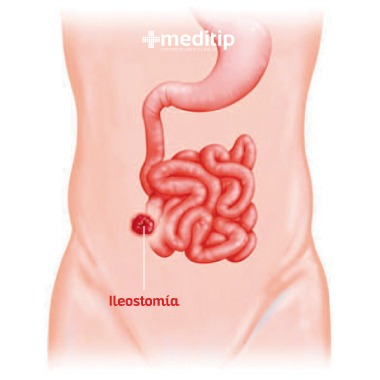 ileostomía: estoma en el íleon