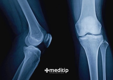Dolor de rodilla al flexionar: radiografía de rodilla