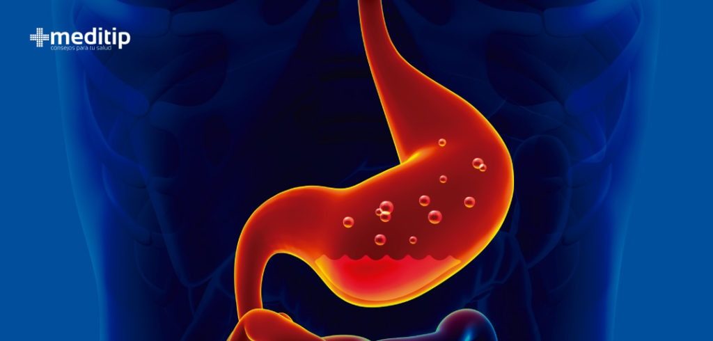 Gastritis crónica: acidez estomacal