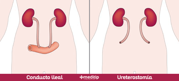 Urostomía: tipos de cirugía de urostomía