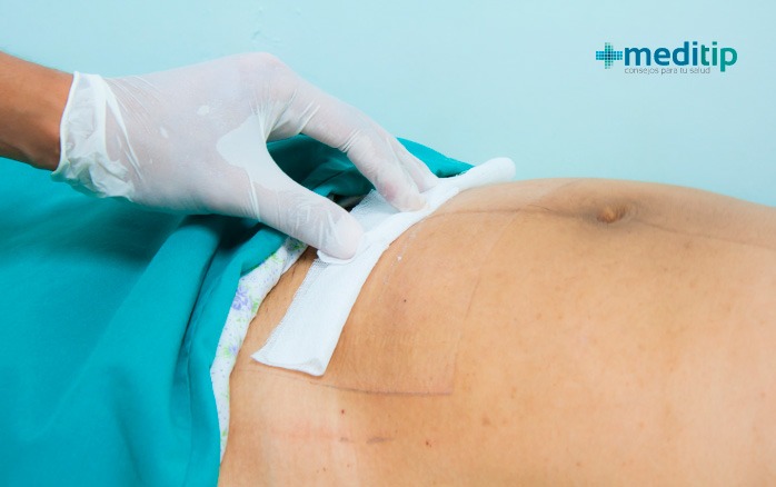 Tecnologías para el manejo de heridas por cesárea: apósito quirúrgico antimicrobiano