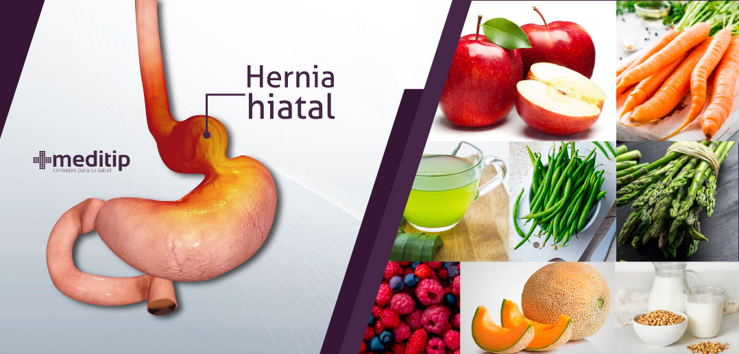 Dieta de la hernia hiatal: hernia hiatal, hernia de hiato