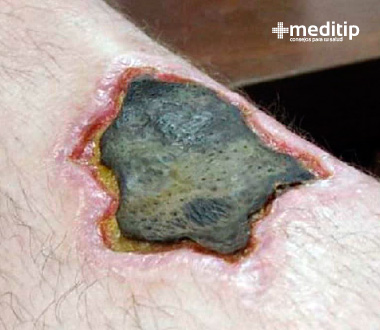 Colores de las heridas: color negro, tejido necrótico o herida necrótica