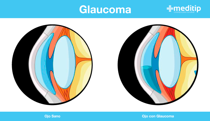 Tratamiento del glaucoma: ilustración de ojo sano y ojo con glaucoma
