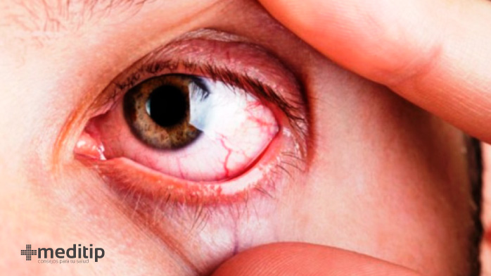 Complicaciones del glaucoma: infección de ojo postoperatoria