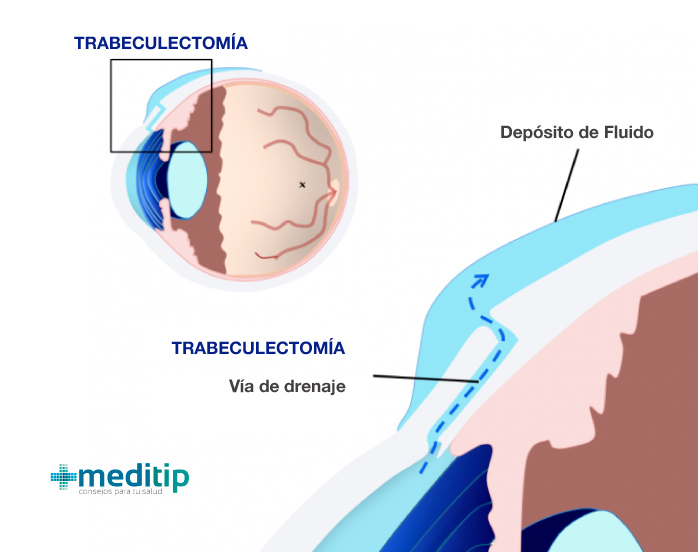 Complicaciones del glaucoma: ilustración de una trabeculectomía