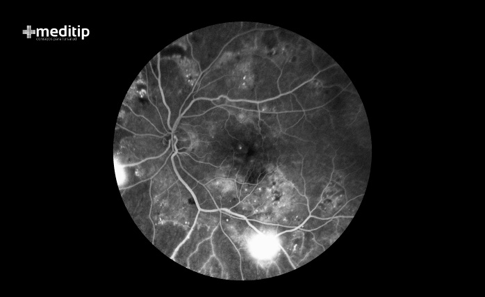 Qué es la retinopatía diabética: angiografía con fluoresceína