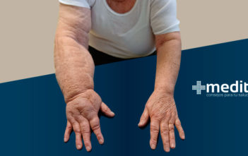 Causas del linfedema y tratamiento, hinchazón en el brazo