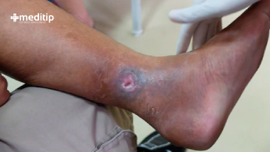 Herida por úlcera en tobillo: Tratamiento de una úlcera venosa