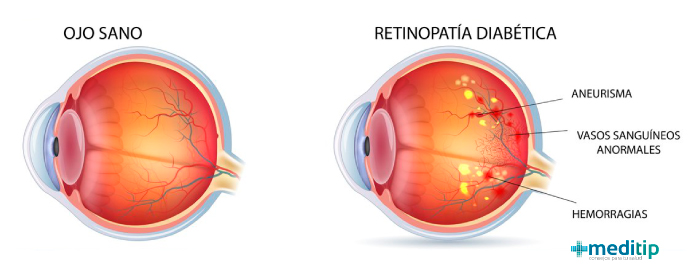 Daño en los ojos por diabetes: ilustración de la retinopatía diabética