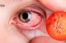 Enfermedad ocular por diabetes: qué es la retinopatía diabética