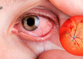 Retinopatía diabética: el daño en los ojos por diabetes