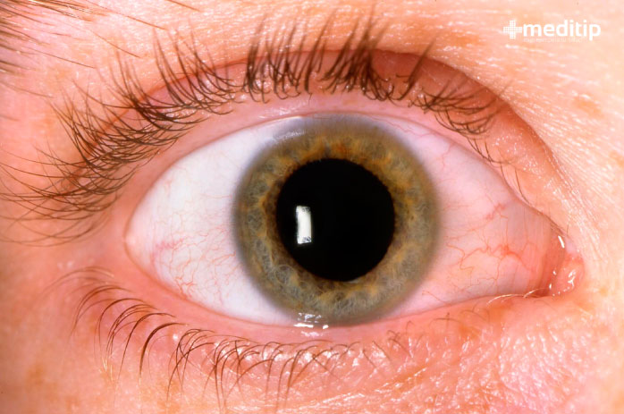 Problemas oculares más comunes: Midriasis, dilatación anormal de la pupila