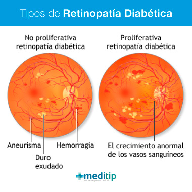 Tipos de retinopatía diabética: etapas de la retinopatía diabética y el daño en los ojos por diabetes