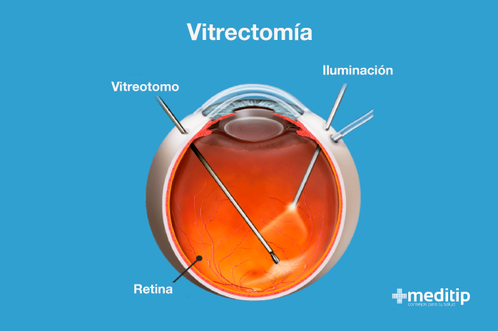 Tratamiento de la retinopatía diabética: Vitrectomía
