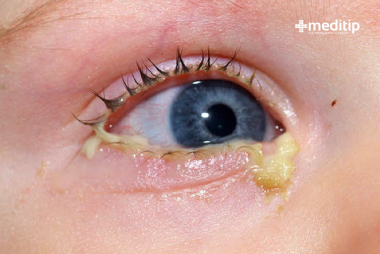 Bebé con infección en el ojo por conductos lagrimales bloqueados