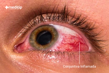 Ojo con conjuntivitis: enrojecimiento de los ojos por inflamación de la conjuntiva