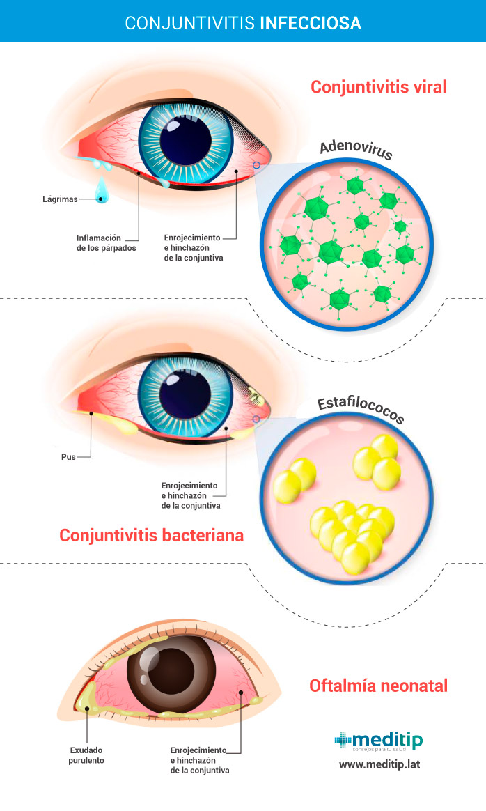 Tipos de conjuntivitis infecciosa: conjuntivitis viral, conjuntivitis bacteriana y oftalmía neonatal