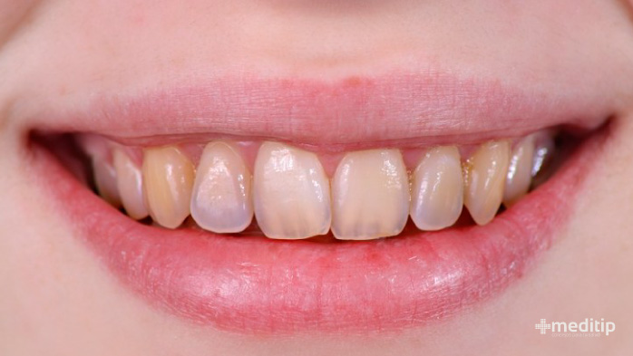 Por qué duelen los dientes: desgaste del esmalte dental