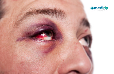 Causas de los ojos rojos: enrojecimiento por lesión en el ojo