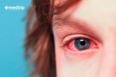 lagrimeo excesivo: ojo llorosos de niño con conjuntivitis alérgica