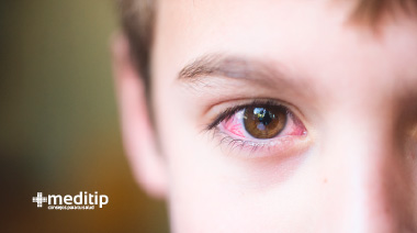 Niño con ojos rojos e irritados: por qué se ponen los ojos rojos